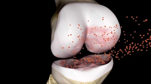 3D animation of knee arthritis caused by viral infection and aging erosion. Vidéo 345199154