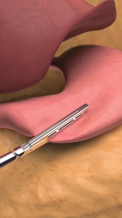 3D animation of laparoscopic sleeve gastrectomy. 库存影片 344953518