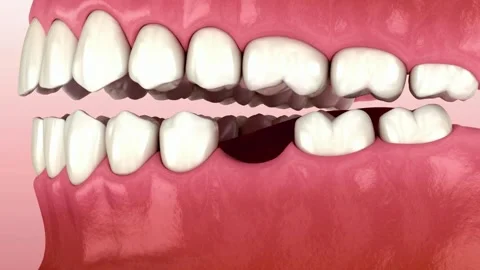 3D Animation of Missing Tooth and Gap in Dental Arch Stock Footage 327667979