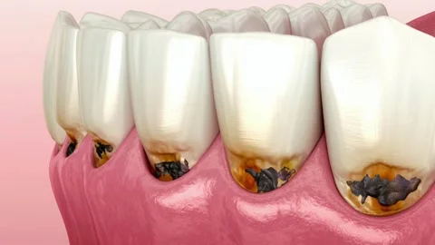 3D Animation Showing Advanced Tooth Decay and Damage Stock Footage 327667733