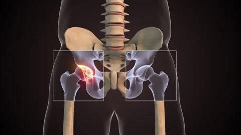 3D Animation Showing Dysplastic Hip Joint Structure Video stock 321994437