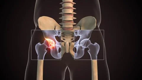 3D Animation Showing Dysplastic Hip Joint Structure Stock Illustration