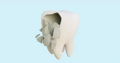 3d animation of tooth enamel destruction in stages spot, caries, treatment, Stock Footage 169449567