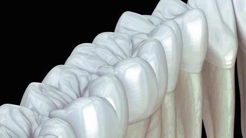 3D Animation of Tooth Extraction and Gap Formation Stock Footage 327668688