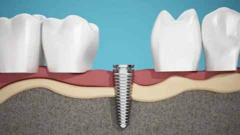 3D animation of a tooth implant procedure viewed from front view Stock Footage 285512211