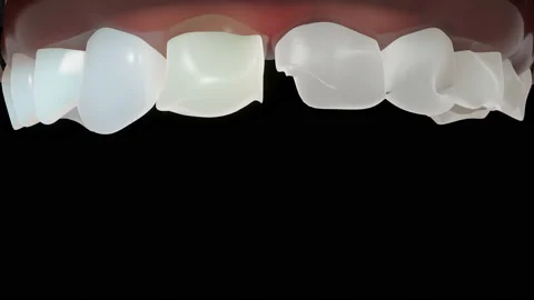 3D animation of the transformation from decayed yellow discolored teeth to even Stock Footage 237437049