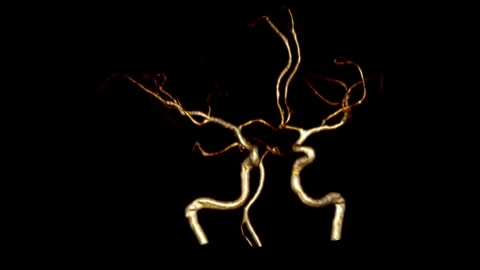 3D Brain MR angiography Stock Footage 314143296