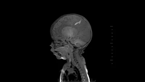 3D Brain View T1W Spir Sequence 12 MRI Scan Stock Footage 259131751