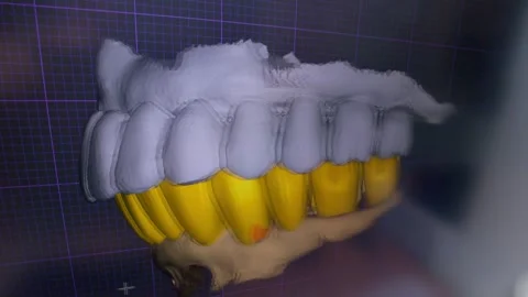 3D CAD CAM Dental Scan Screen Showing Digital Teeth Model Stock Footage 340480199