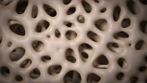 3D CG animation of osteoporosis bone micro structure Video stock 82942691