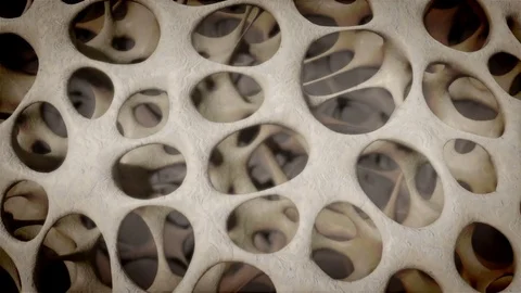 3D CG Animation of Osteoporosis Process in Leg Bone Video stock 82177704