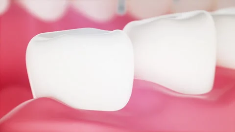 3d clean and dirty tooth , clearing tooth process. Teeth Whitening. Dental healt Stock Footage 208687815