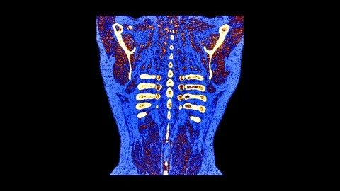 3D Color Mri Scan Of The Lungs Stock Footage 117115084