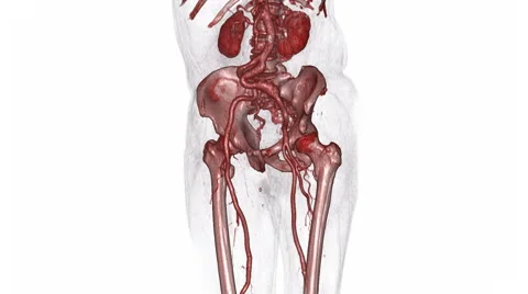 3D CT reconstruction of an abdominal aneurysm Video stock 64803687