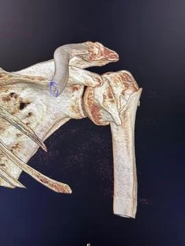 3D CT scan of the shoulder joint Stock Photos
