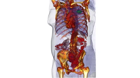 3D CT scan showing lung cancer 스톡 동영상 64804274