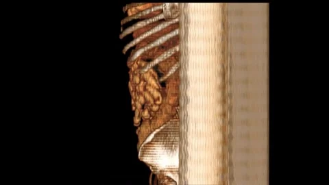 3D CTA of Whole Aorta with Rotating Image for Diagnosing Aortic Dissection Stock Footage 281434492
