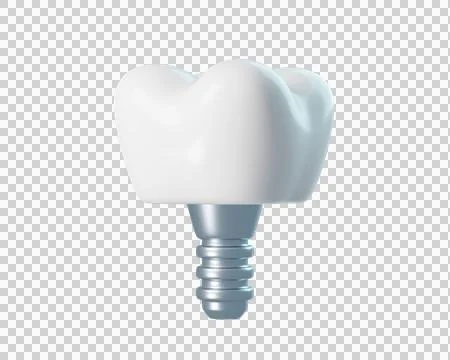 3D Dental Implant Stock Illustration