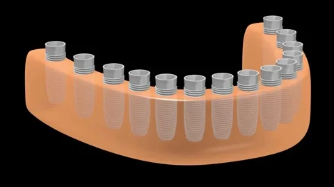 3D Dental Implants in Jawbone 스톡 동영상 301610158