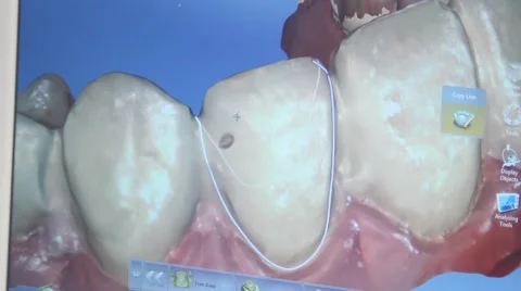 3D dental restoration process Stock Footage 61155900