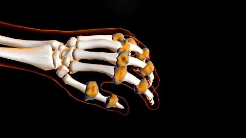 3D Dynamic Visualization of Various Joint and Skeletal Diseases-Bone hyperplasia 스톡 동영상 329805166