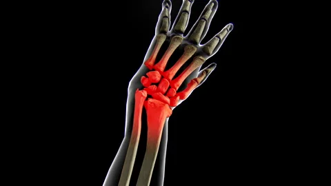 3D Dynamic Visualization of Various Joint and Skeletal Diseases-wrist joint Stock Footage 329805291