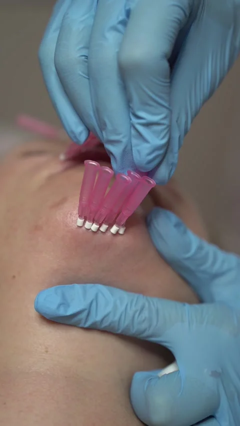 3D facelift with PDO mesothreads. Anti-aging cosmetology. Vertical 4K video. Video stock 289189024