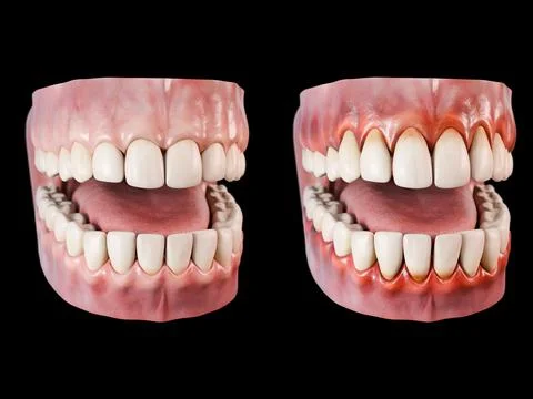 3d Illustration Of Periodontitis Stock Illustration