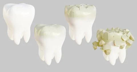 3d illustration render of tooth enamel destruction in stages caries Illustrazione stock