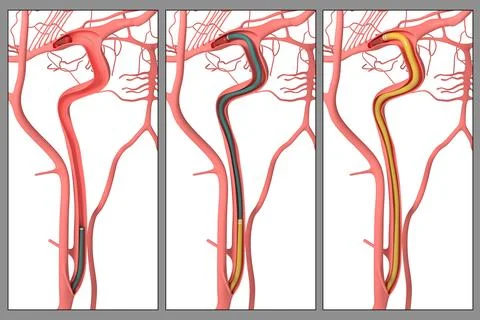 3d Illustration of  Sequence of the Aspiration Procedure of a Brain Clot Stock Illustration