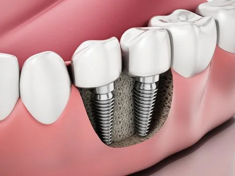 3D illustration of two dental implants on the lower jaw Stock Illustration