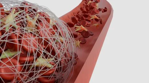 The 3D image of thrombus formation within a blood vessel Stock Illustration