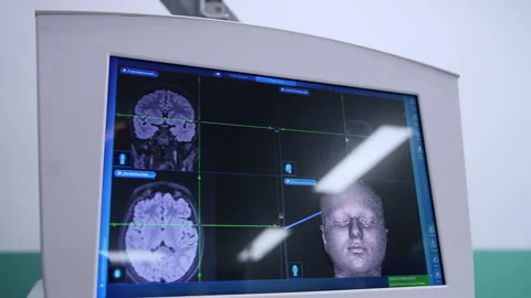 3d imaging of the patient's head and brain. Stock Footage 302590012