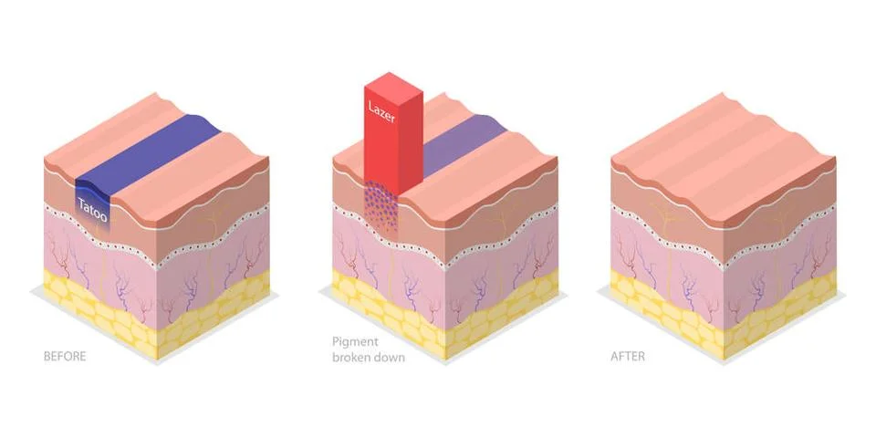 3D Isometric Flat Conceptual Illustration of Laser Tattoo Removing, Cosmet... Stock Photos