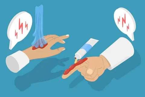 3D Isometric Flat Conceptual Illustration of Skin Burn Injury Behandlung, ... Stock Photos