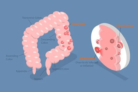 3D Isometric Flat Conceptual Illustration of Diverticulitis, Medical Sruct... 스톡 사진