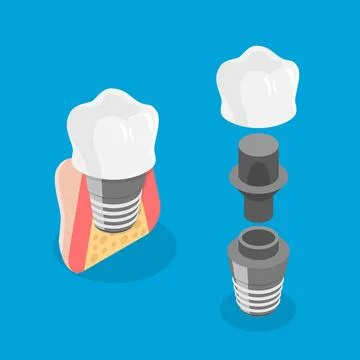 3D Isometric Flat Illustration of Tooth implant, Dental Prosthesis3D I... Stock Photos