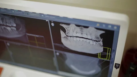 3D the jaw on a computer screen Stock Footage 98526902