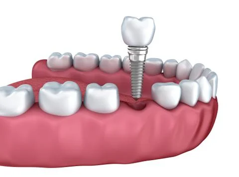 3d lower teeth and dental implant isolated on white Stock Illustration