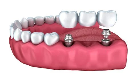3d lower teeth and dental implant isolated on white Stock Illustration