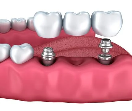 3d lower teeth and dental implant isolated on white Stock Illustration