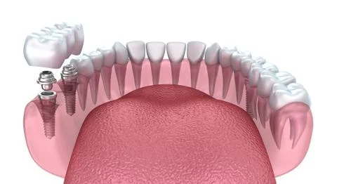 3d lower teeth and dental implant transparent render isolated on white Stock-Illustration
