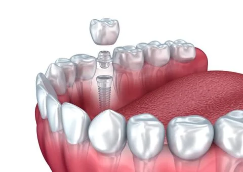 3d lower teeth and dental implant isolated on white Stock Illustration