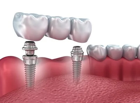 3d lower teeth and dental implant isolated on white Stock Illustration