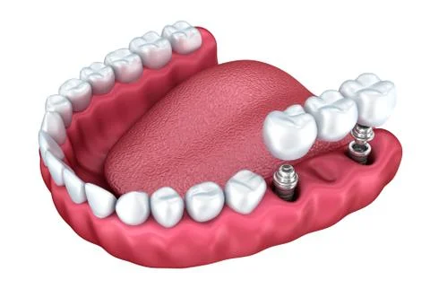 3d lower teeth and dental implant isolated on white Stock Illustration