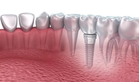 3d lower teeth and dental implant transparent render isolated on white Stock-Illustration