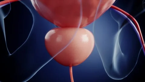 3D medical rendering of prostate enlargement obstructing urine flow Stockbeeldmateriaal 345015377