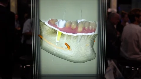 3D Model of Implants Vídeos de archivo 92620040