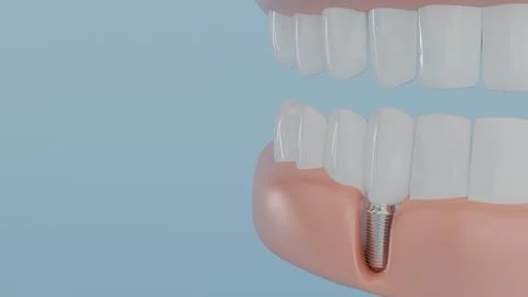 3D model of teeth on the jaw and a dental implant implanted in the gum on a.. Stock Photos