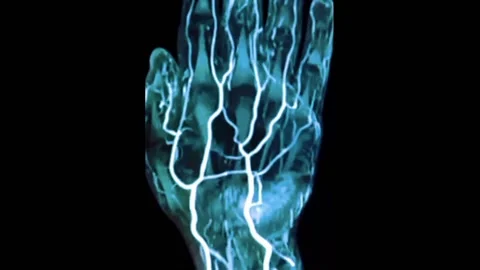 3d MRI Scan Hand Blood Vessels Stock Footage 172592352